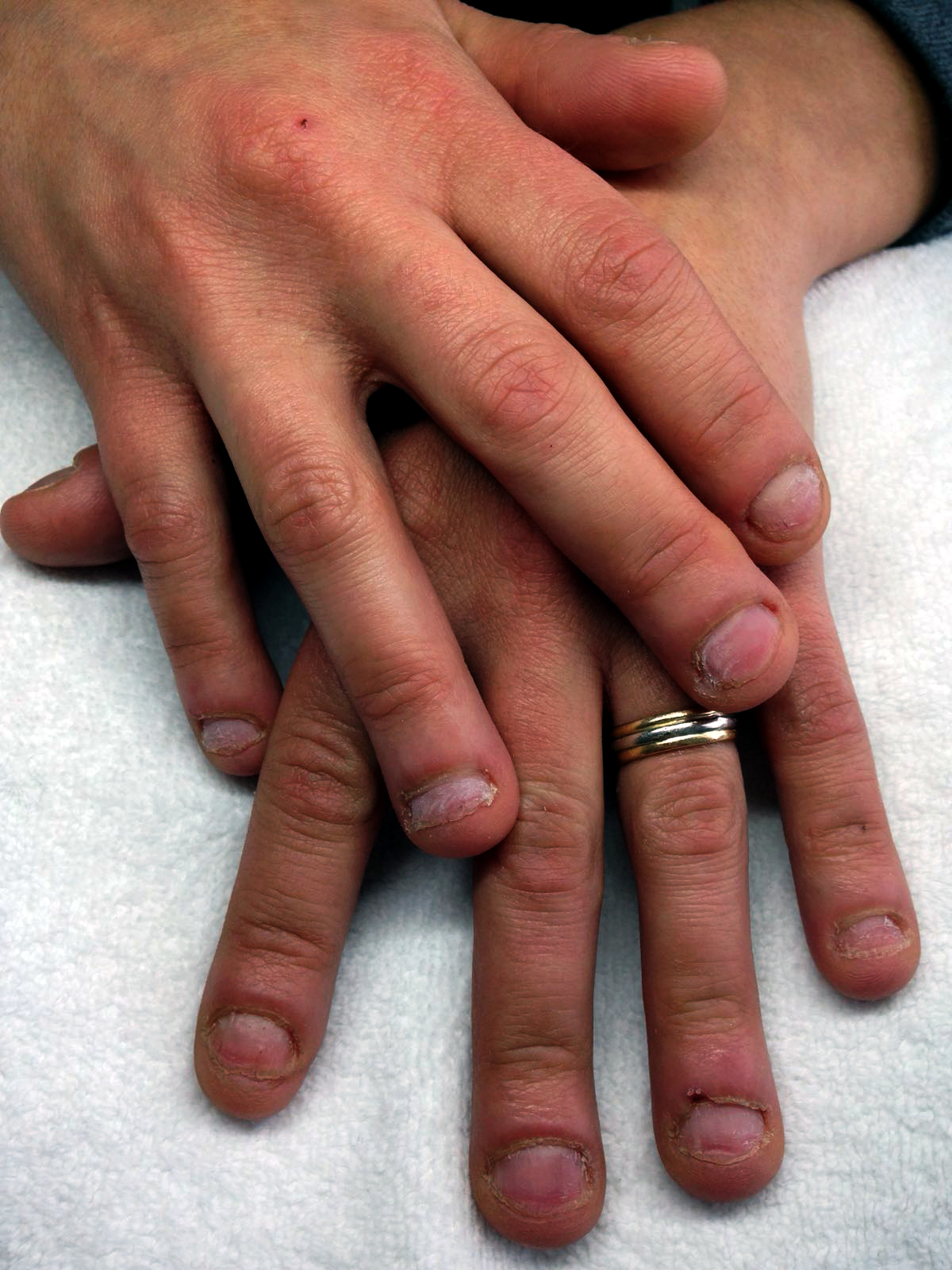 Avant : ongles ab&icirc;m&eacute;s